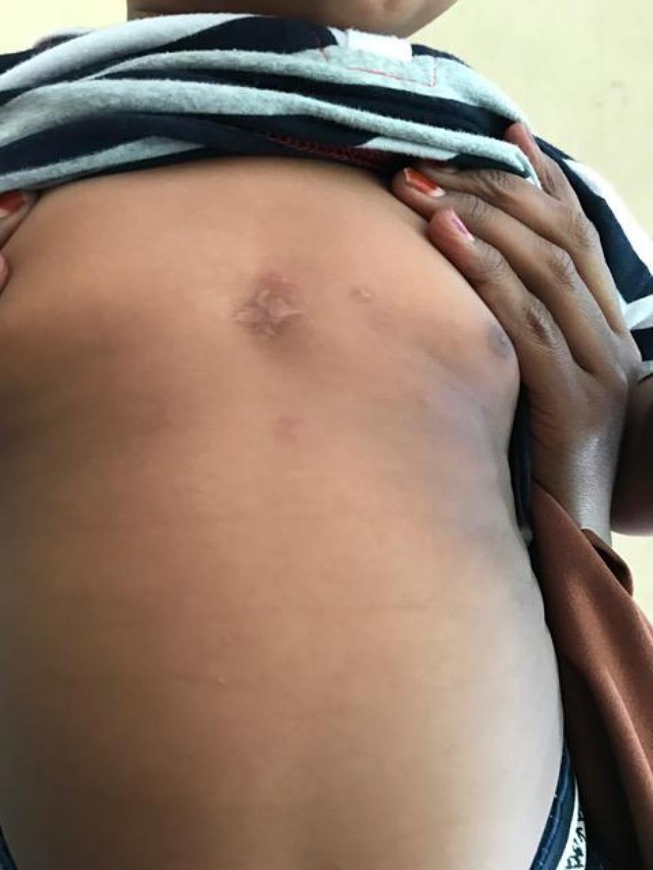 A toddler shows a scar from the shot he sustained in the chest during the Jamaac Dubad killings, when he was 5-months-old. His mother and grandmother were killed in the incident, December 2016.