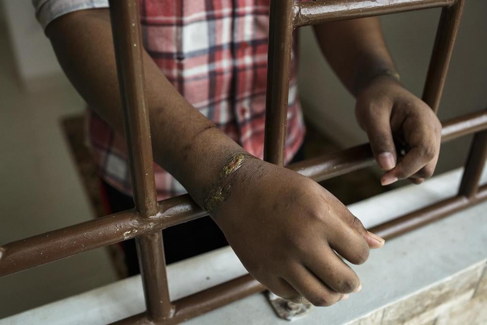 A male resident staying in the isolation room at the Galuh Rehabilitation Center in Bekasi has wounds on his arms resulting from being tied.
