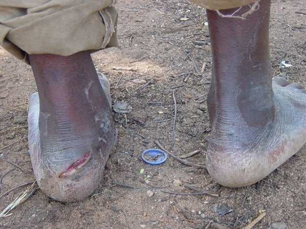 English: An FNL deserter tortured at a police post in Cibitoke province, Burundi &copy 2006 Human Rights Watch