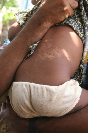 The scarred back of a young girl wounded in the shelling of the Kathiravelli school grounds on November 8, 2006. Human Rights Watch found no evidence that in this incident the LTTE used civilians as human shields, as the government claimed.© 2007 Fred Abrahams/Human Rights Watch