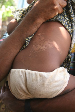 The scarred back of a young girl wounded in the shelling of the Kathiravelli school grounds on November 8, 2006.  Human Rights Watch found no evidence that in this incident the LTTE used civilians as human shields, as the government claimed.© 2007 Fred Abrahams/Human Rights Watch