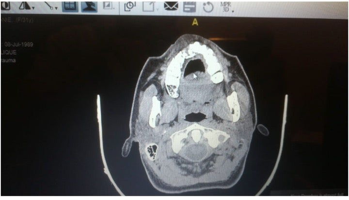 تظهر الأشعة السينية كسرا في عظم الفك العلوي لمتظاهرة بعد أن أصيبت برصاصة مطاطية.