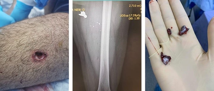 Security forces fired a bullet at Omar that hit his upper left thigh. The image on the left shows the entrance wound. The X-ray shows three large bullet fragments and several smaller fragments in his left leg, and the image on the right shows the fragments extracted from his leg. 