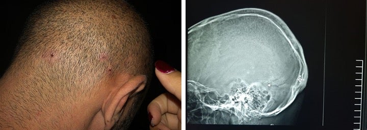 أصيب إيلي صليبا بالخردق. على اليمين، تُظهر الأشعة السينية إحدى حبات الخردق مغروسة في رأسه.