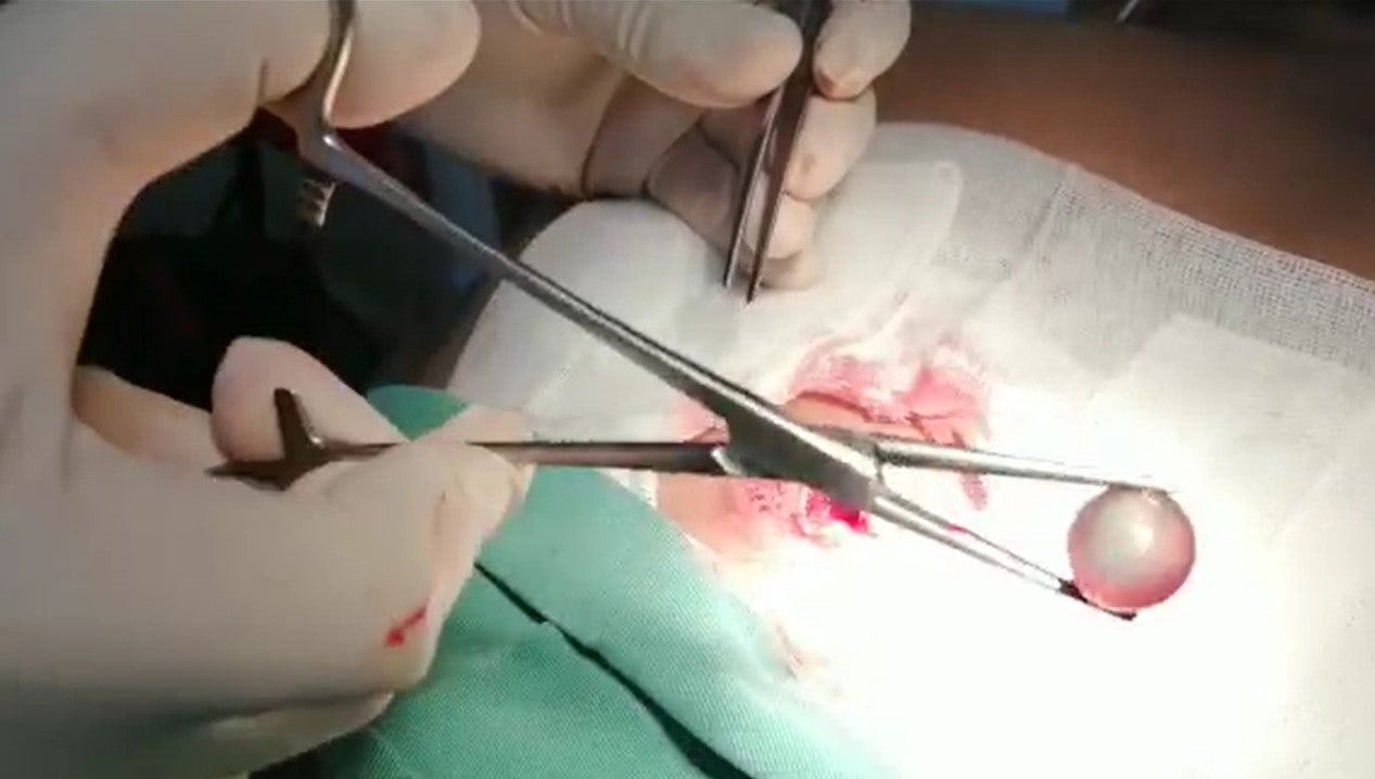 Imagen de un video del procedimiento quirúrgico que se llevó a cabo para extraer una canica de la espalda a Alonso Chero. Video proporcionado por Alonso Chero. 