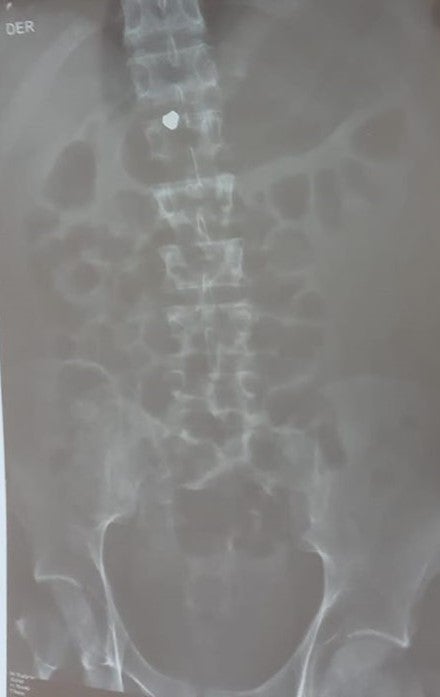 X-ray showing a pellet, believed to be lead, lodged in Jon Cordero’s spinal cord. Photograph courtesy of Jon Cordero’s family.