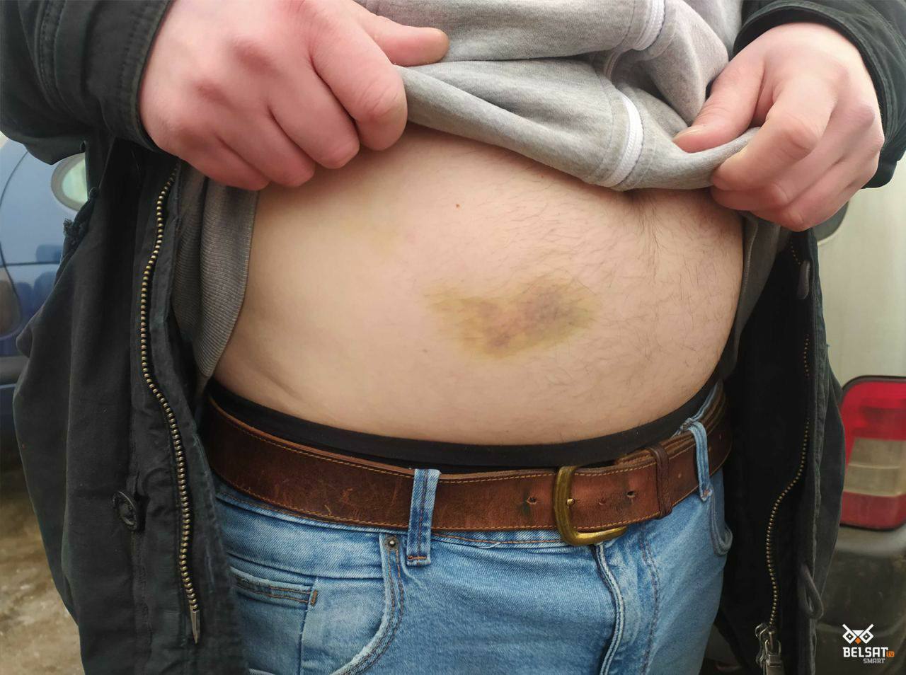 Dmitry Soltan shows bruises still visible on his stomach sustained during his 15 days in detention. Soltan says he was beaten on the stomach and lower back with a truncheon by a guard at the detention facility Okrestina.