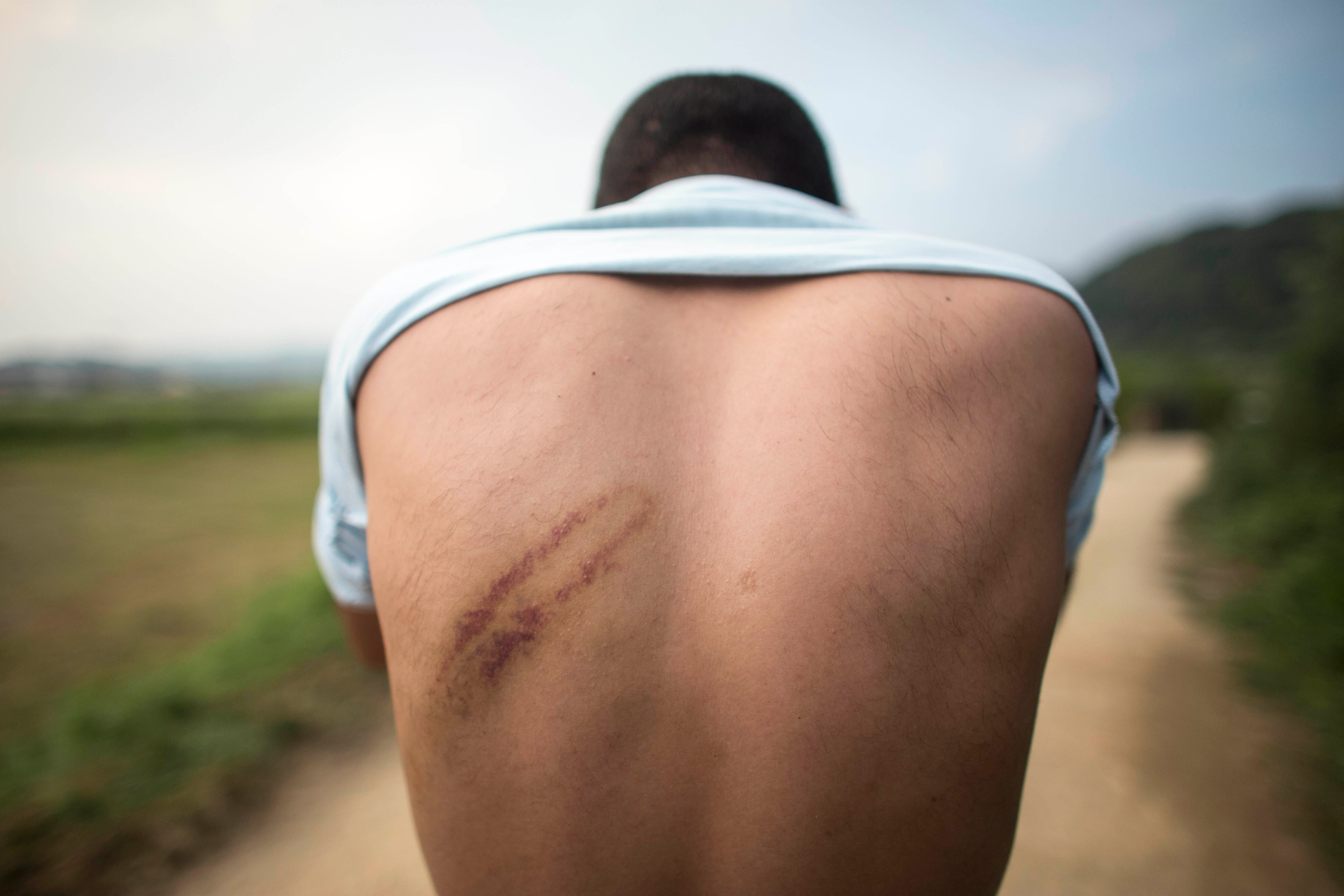 A refugee in Bosnia and Herzegovina shows injuries he says were the result of a beating by Croatian police August 2018.