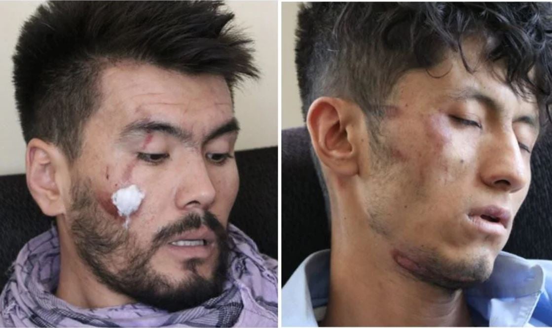 Deux journalistes afghans qui ont été sévèrement battus par les talibans, après qu’ils eurent tenté de couvrir une manifestation à Kaboul, le 7 septembre 2021.