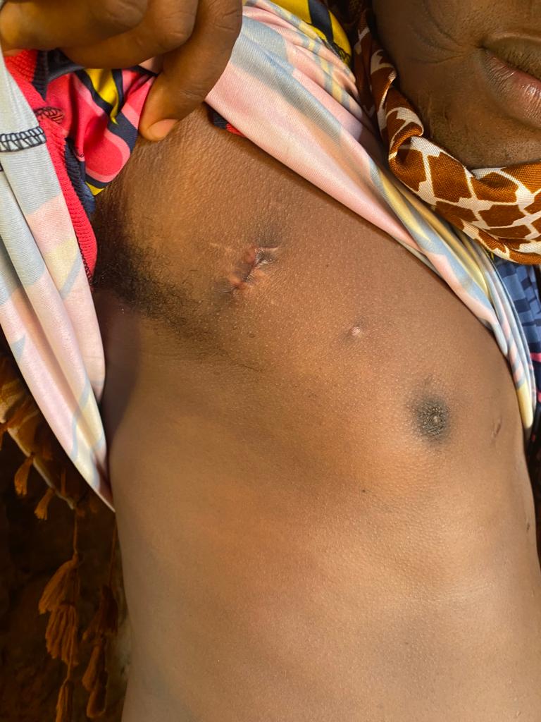 A survivor of the airstrike showing one of the injuries he sustained from shrapnel during the incident. Photo taken on March 14, 2023.