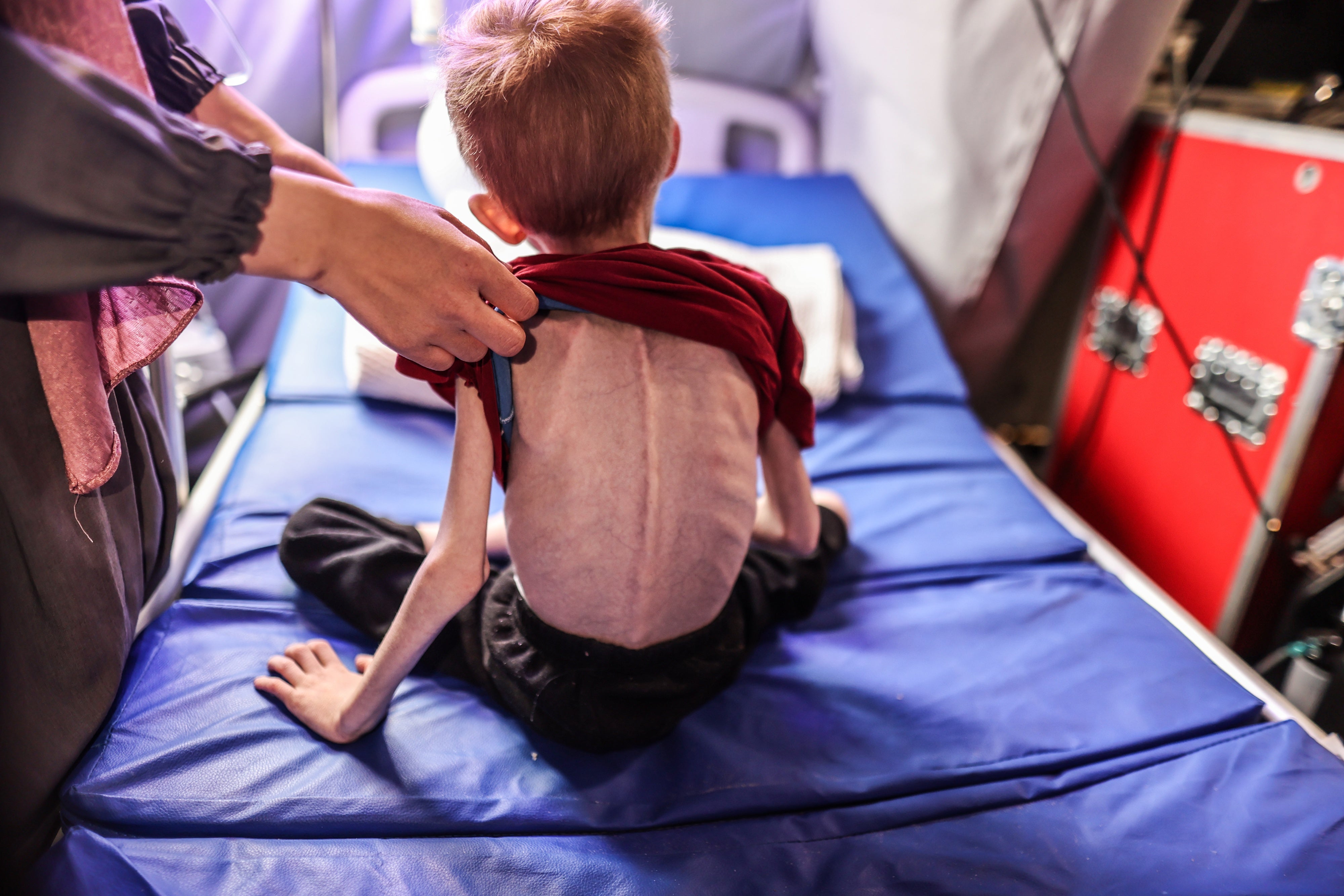 F., un jeune garcon de 6 ans souffrant de malnutrition, recevait des soins après avoir été évacué du nord de la bande de Gaza vers l'hôpital de campagne IMC à Rafah, Gaza, le 24 mars 2024. 