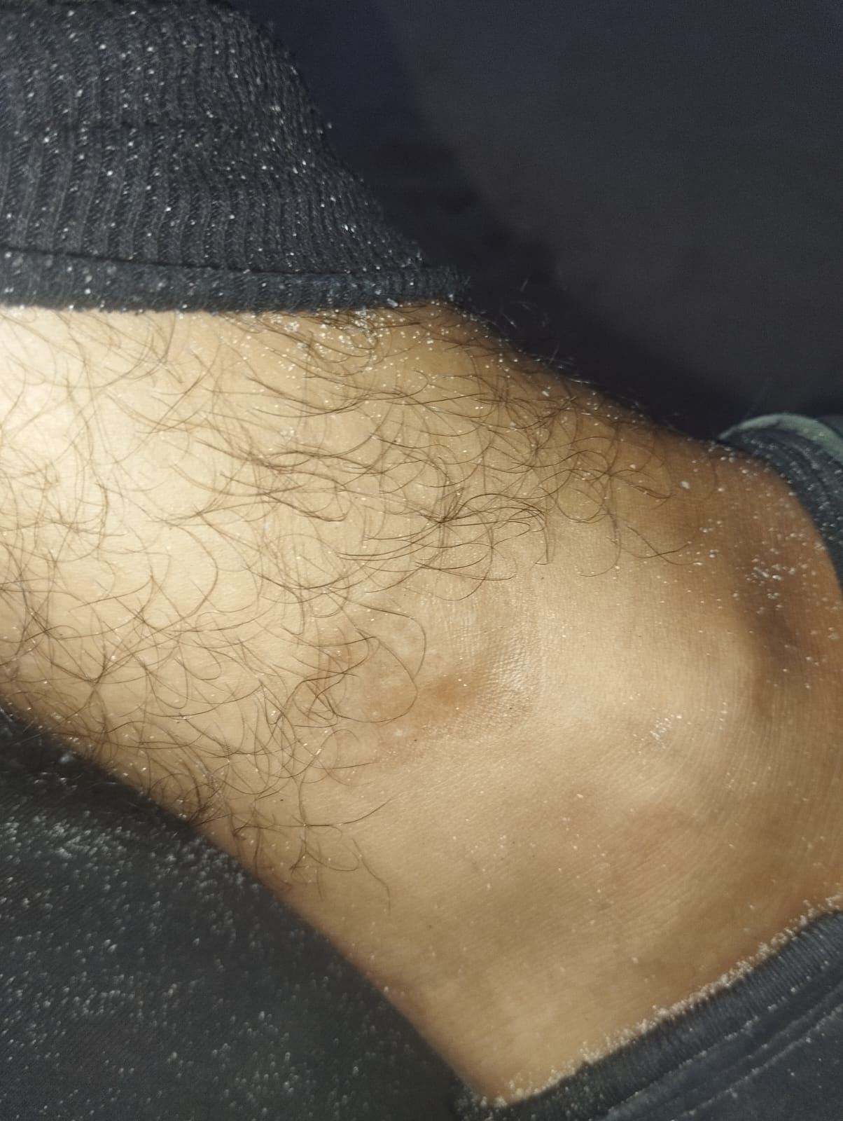 علامات مرئية على ساق وليد خليلي ناجمة عن الأصفاد والصعق بالكهرباء. التقطت الصورة حوالي 8 أبريل/نيسان 2024 بعد الإفراج عن خليلي من الاحتجاز الإسرائيلي.