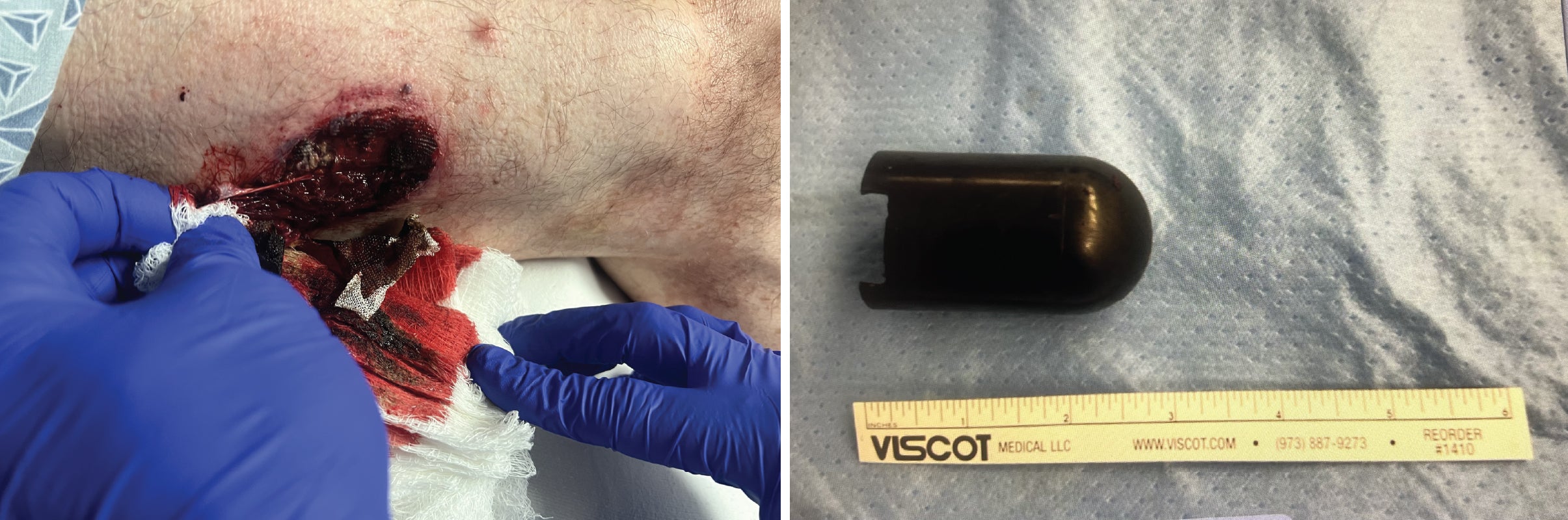 A photo of a close-up wound and a photo of a canister from a flash-bang