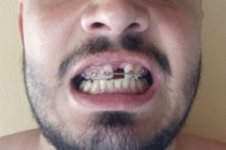 Photo of a gap left in Luis S.’s mouth after losing a tooth. 