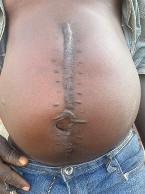Scars from surgery on a person's abdomen