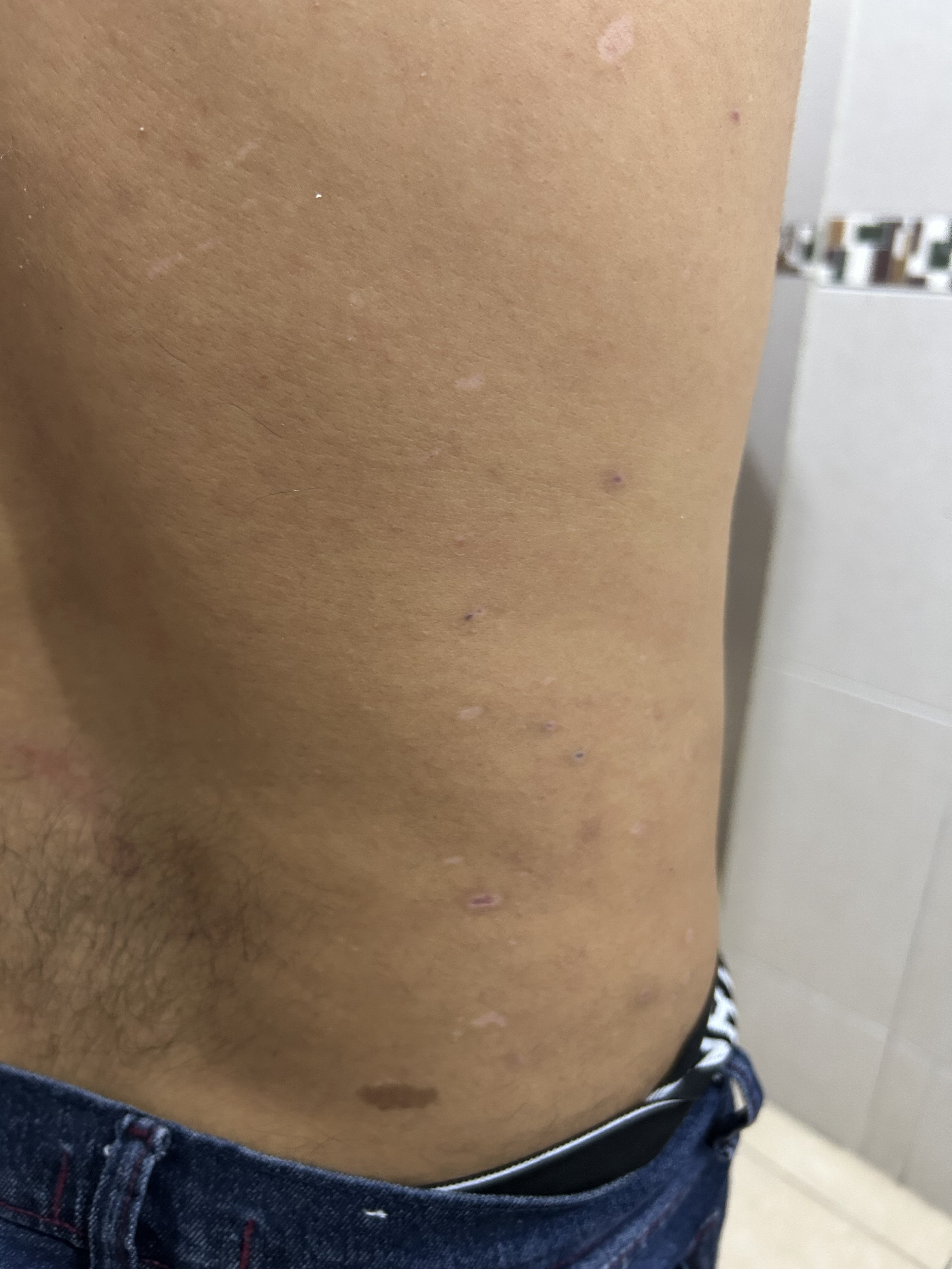 Glass fragment injuries
