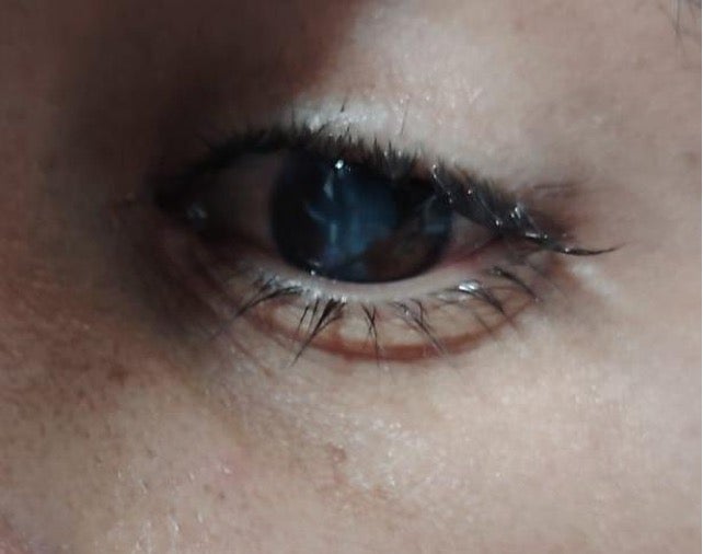 injuries to an eye