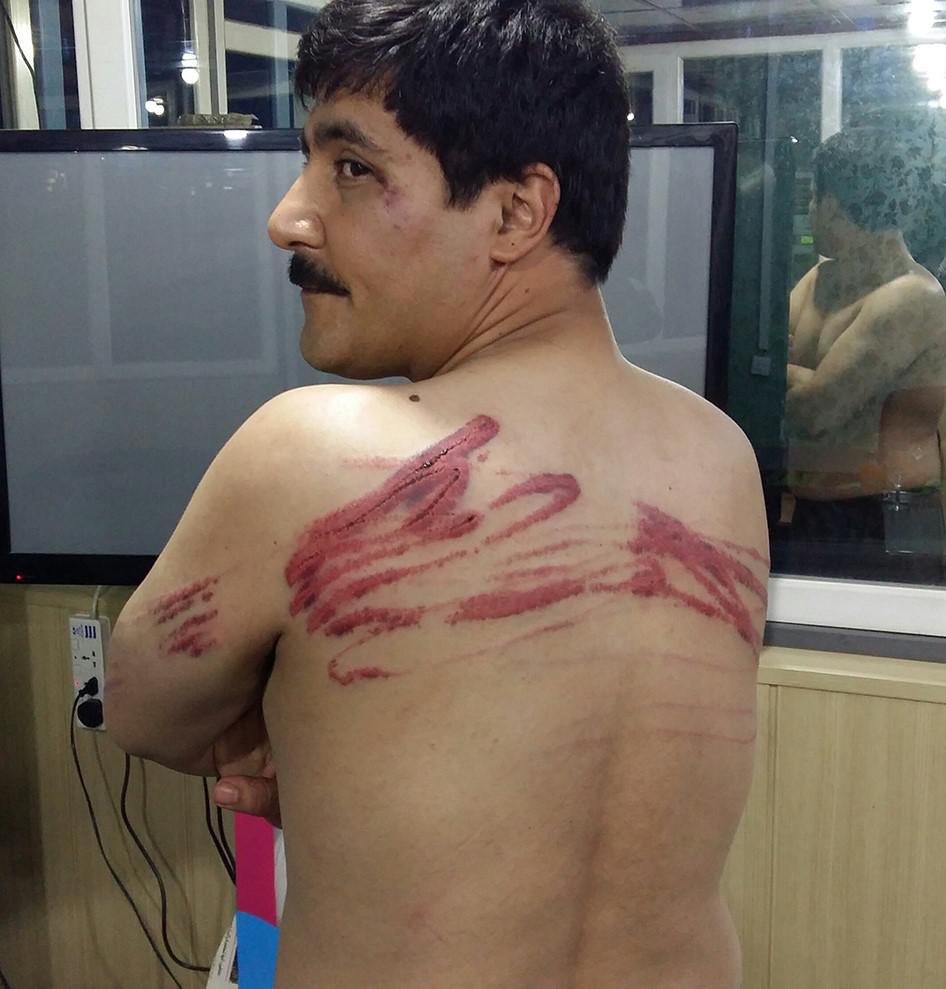 Visible injuries suffered by a protester in Baghdad, Iraq after being detained and beaten with cables by unidentified attackers in civilian clothes on September 18, 2015. Photo taken September 20, 2015. 