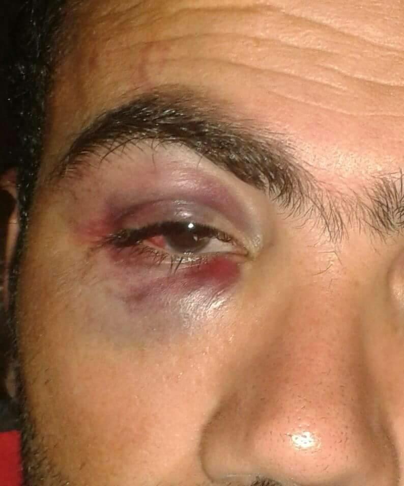 Hassan’s injury on his eye after masked men beat him and other passengers and then punctured their boat.
