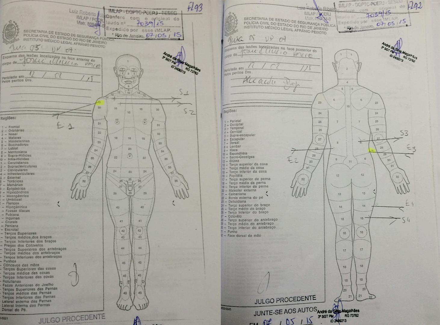 The autopsy diagrams in the case of Josué Oliveira Pereira show he was shot once in the back (marked by entry wound “E2”), once in the back of the leg (“E4”), once on the side (“E3”), and once in the shoulder from the front (“E1”). E1 and E3 had abrasion 