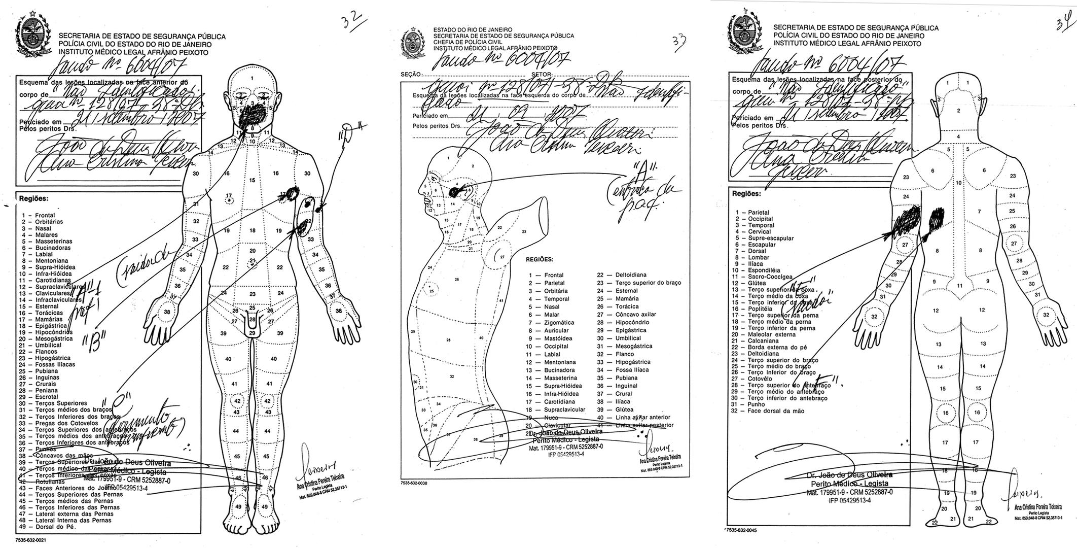 The autopsy diagrams in the case of Renato Gomes Prado show an entry wound marked “A” on the left side of the head (diagram on page 65). As it exited, the bullet left a 7-centimeter hole through the mouth and nose, marked “A1.” The diagrams also show a 4-