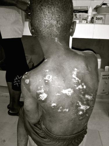 The talibé child depicted, age 8, was severely beaten by his Quranic teacher in Senegal’s northern city of Saint-Louis, in August 2015. 
