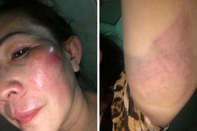 Nguyen Thi Thai Lai after being assaulted in Nha Trang on February 12, 2017. 