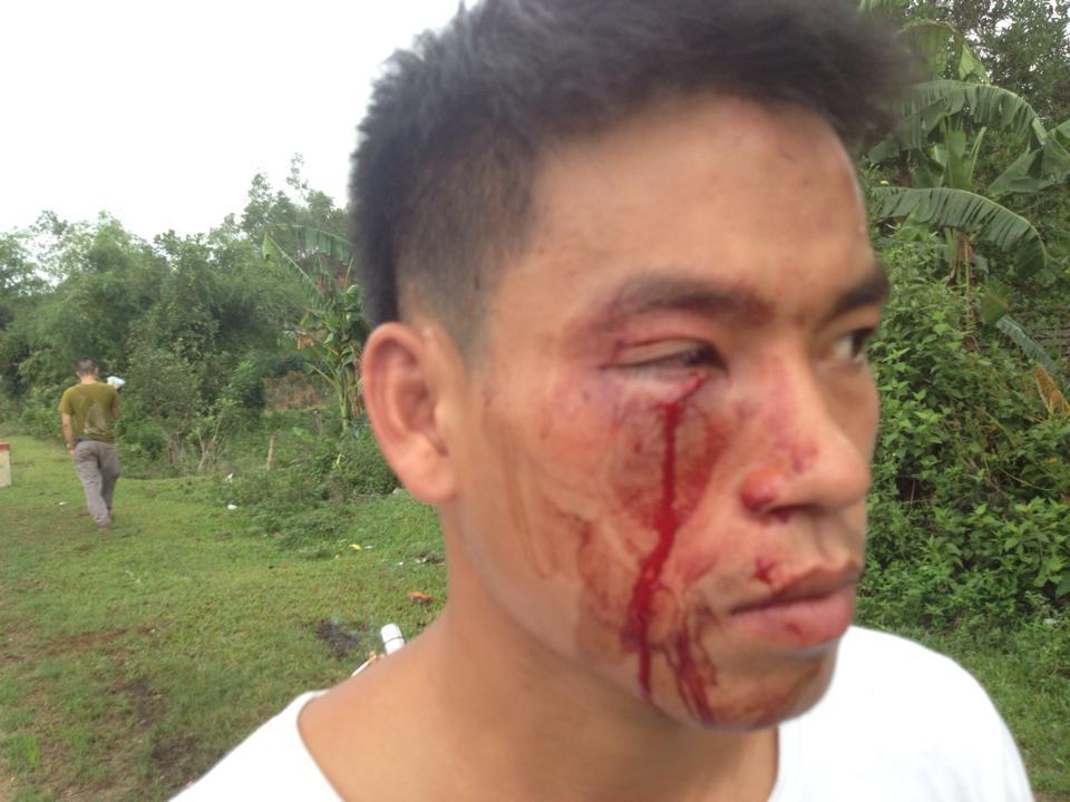 Trinh Ba Tu after being assaulted in Nghe An on June 25, 2015.
