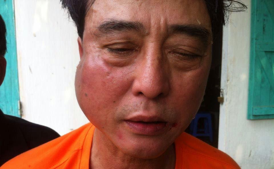 Lai Son Tien after being assaulted in Hanoi on March 18, 2015.