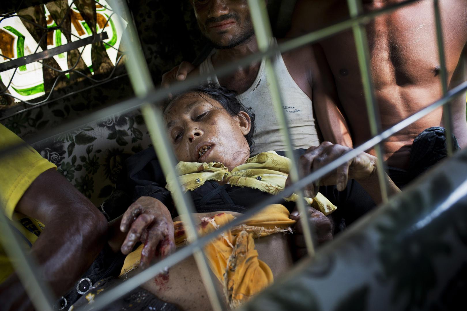 一名罗兴亚妇女在穿越缅甸边境途中遭地雷炸残右腿，被送往孟加拉库图帕隆（Kutupalong）附近的医院急救，2017年9月4日。