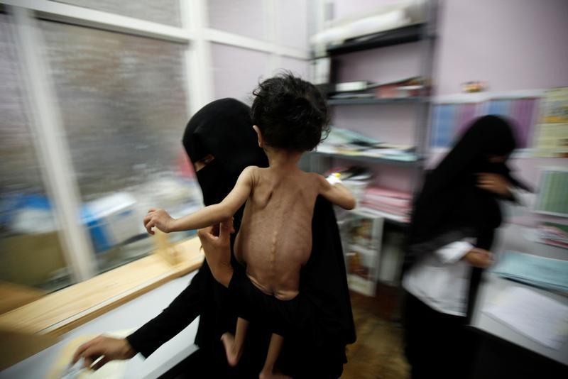 Une femme transporte son enfant gravement malnutri dans une unité de soins intensifs d'un hôpital à Sanaa, au Yémen, le 27 septembre 2016.