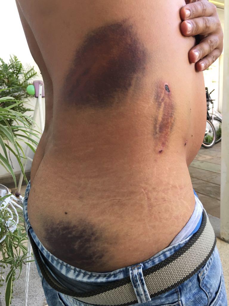 Activist Luaty Beirao showing bruises he sustained from baton strikes, Luanda, February 24, 2017.