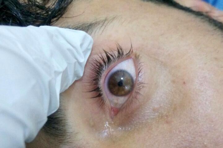 Severely constricted (“pinpoint”) pupil of a man injured in attack near al-Lataminah on March 30 according to the Syrian American Medical Society. 