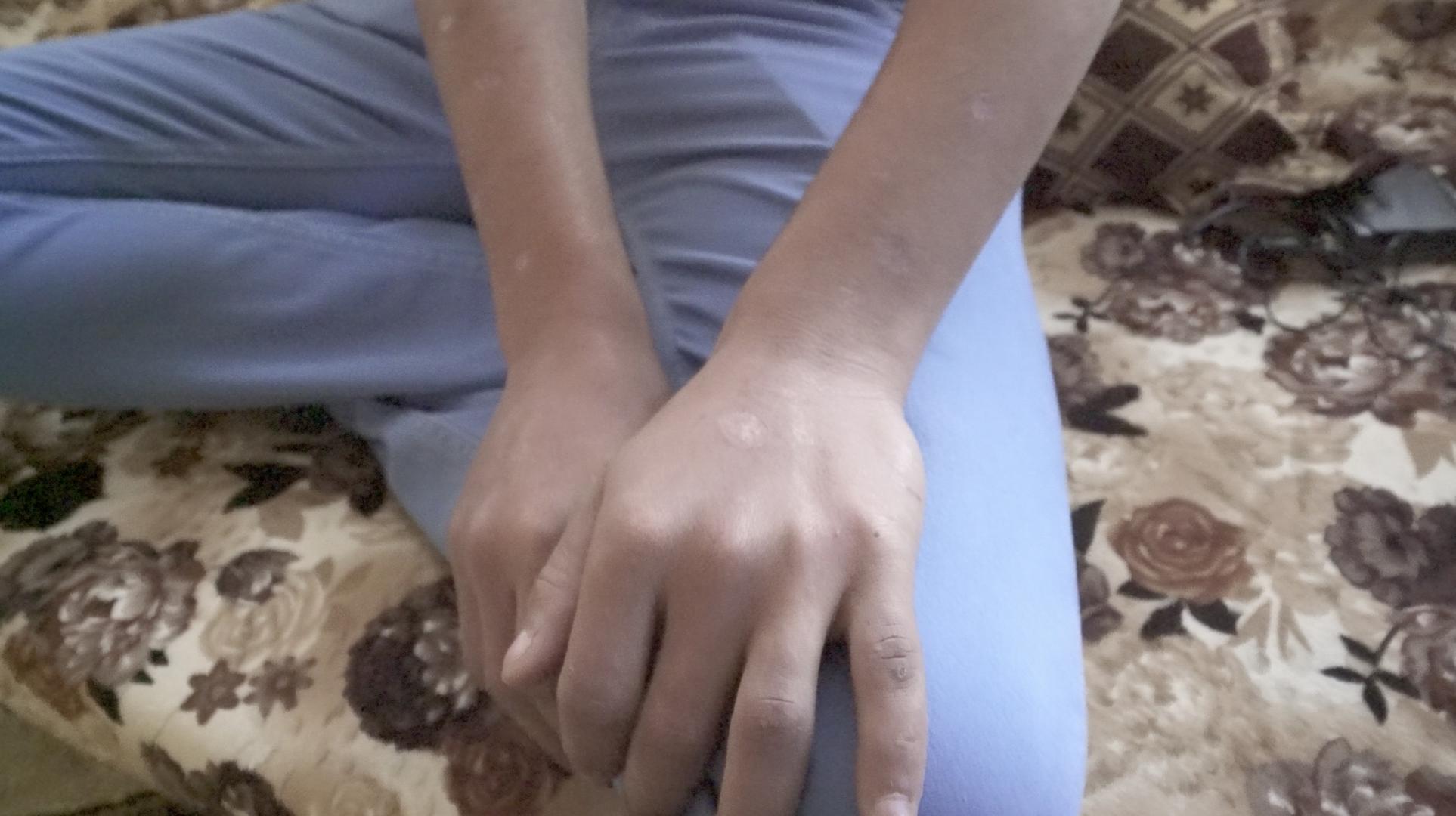 حروق السجائر تغطي يدي وذراعي كريم(18 عاما) الذي احتجزته السلطات الكردية لمدة 13 شهراً. عاد بعد إطلاق سراحه إلى منزله ليتم اعتقاله مجدداً من السلطات التابعة لبغداد التي عذبته واحتجزته لأشهر. @2018 سان سرافان