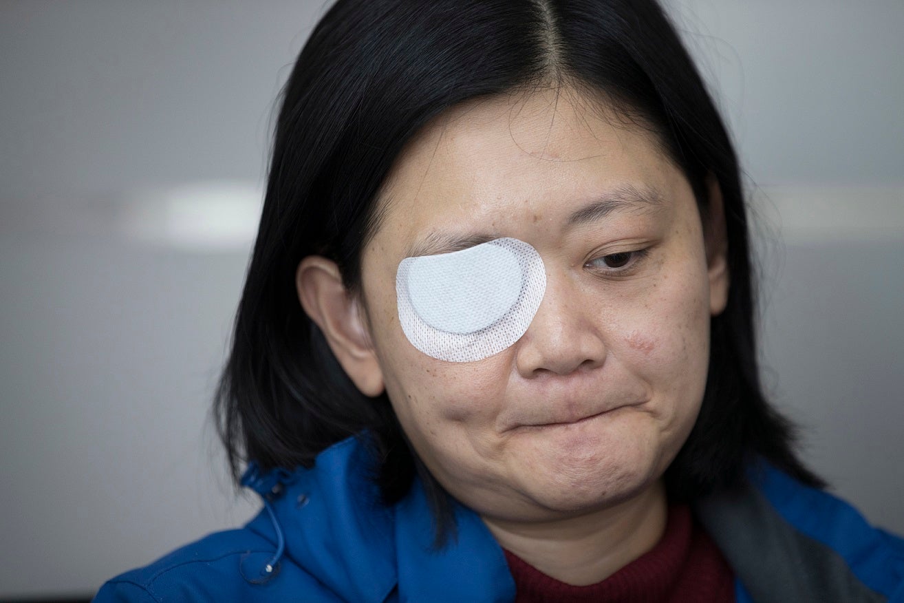 In this Wednesday, Dec. 4, 2019, photo, Veby Mega Indah, an injured Indonesian video journalist, bites her lips during an interview with The Associated Press in the Wan Chai area of Hong Kong.