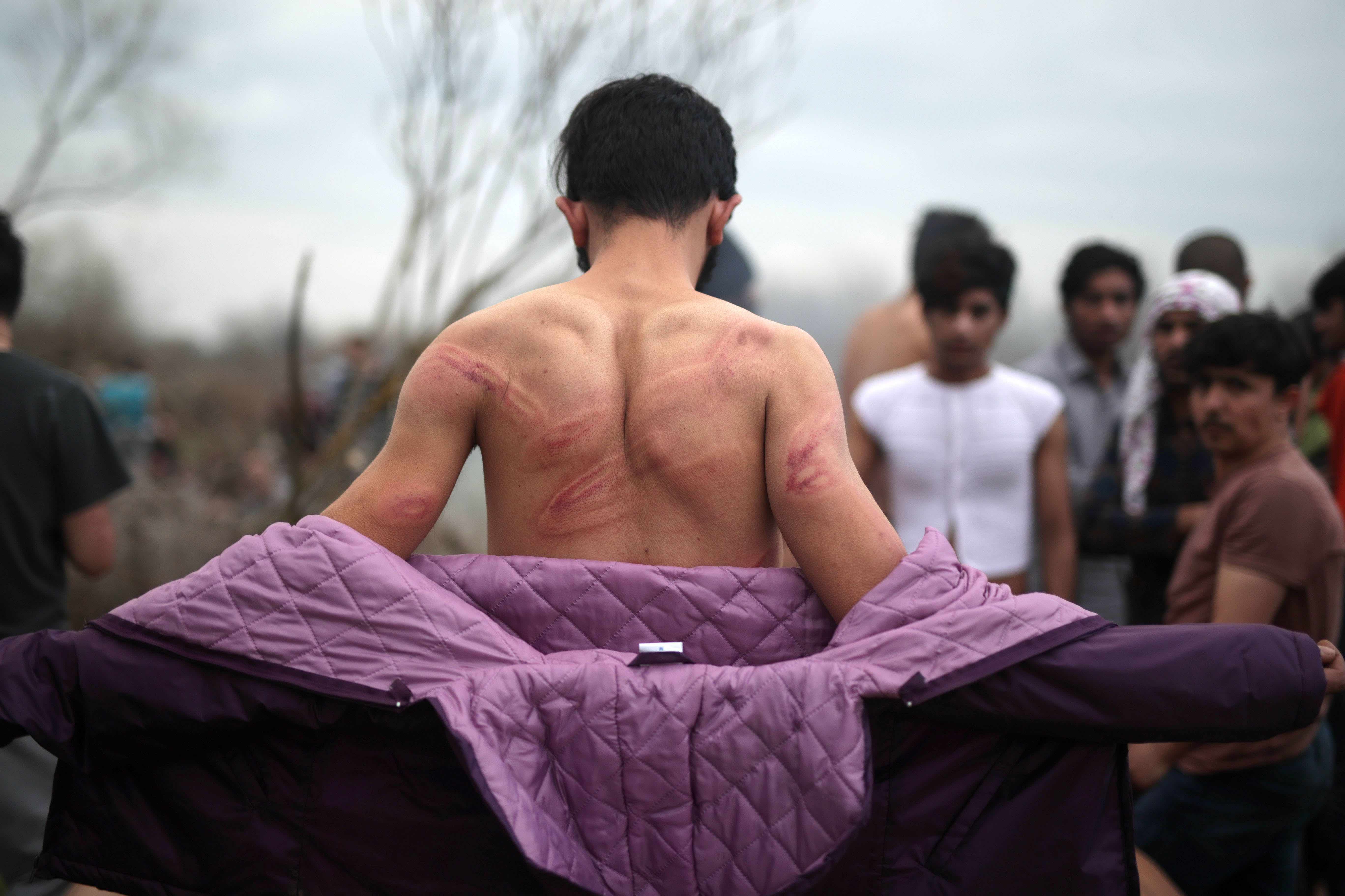 Türkiye’nin Yunanistan sınırındaki bir mülteci, Meriç nehrinden Yunanistan’a geçtikten sonra, Yunanlı güvenlik güçlerinin sebep olduğunu söylediği yaralarını 6 Mart günü gösteriyor. Fotoğraf Türkiye Radyo Televizyon Kurumu/El ilanı/Anadolu Ajansı.