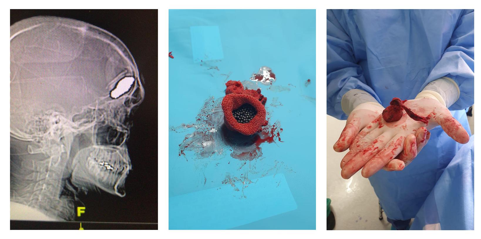 Radiografía de un paciente alcanzado por un cartucho de impacto de tipo “bean bag” e imágenes de la munición extraída del cráneo del paciente el 28 de octubre de 2019. 