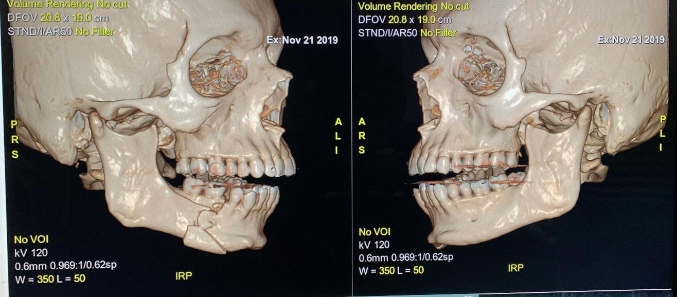 Imágenes de la mandíbula fracturada de Inda tomadas en el Hospital Carlos Van Buren en Valparaíso. 
