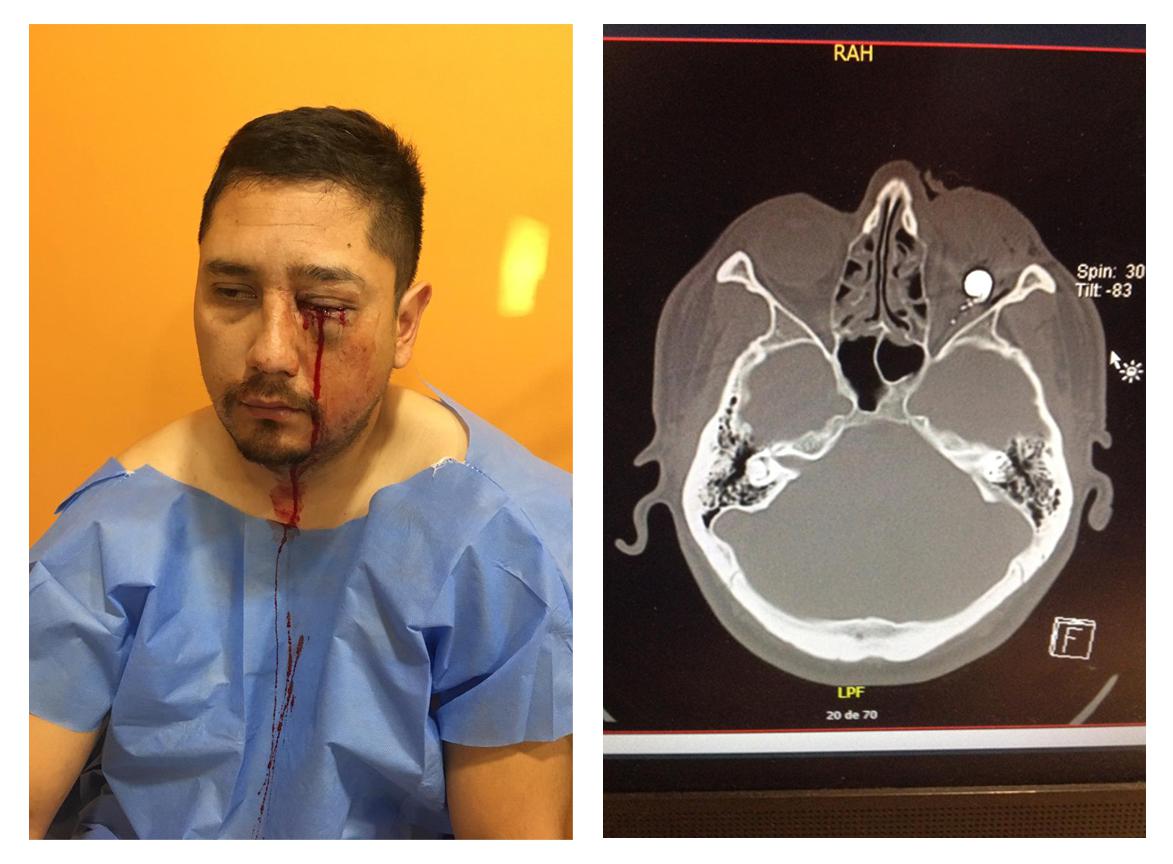 Ronald Barrales al llegar al Hospital Santa María Hospital el 11 de noviembre. A la derecha, en una radiografía el perdigón que le impactó en el ojo se observa como un objeto redondo brillante.