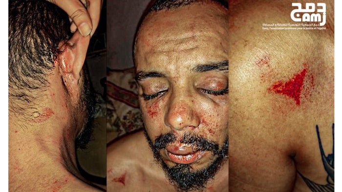 Badr Baabou, director of Damj Association for Justice and Equality, following his assault by suspected police officers in Tunisia. © 2021 Badr Baabou