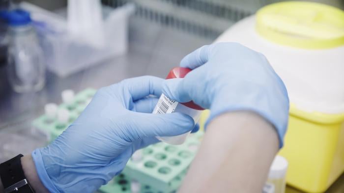 A nurse holds one of the tests for monkeypox at the Hospital Ramón y Cajal, May 30, 2022, in Madrid, Spain. © 2022 Carlos Luján/Europa Press via AP  