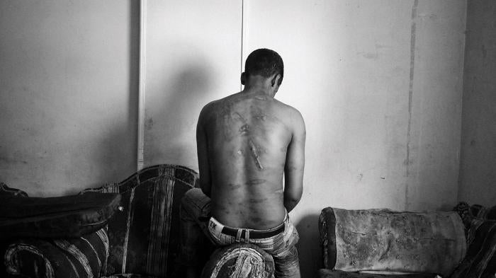 The scarred back of an Eritrean asylum seeker in Cairo who says Egyptian traffickers tortured him for ransom in Egypt’s Sinai peninsula by dripping molten plastic onto his back, May 2013.