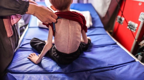 F., age 9, experiencing malnutrition, receives treatment after being evacuated from the northern Gaza Strip to the IMC field hospital in Rafah, Gaza, March 24, 2024.