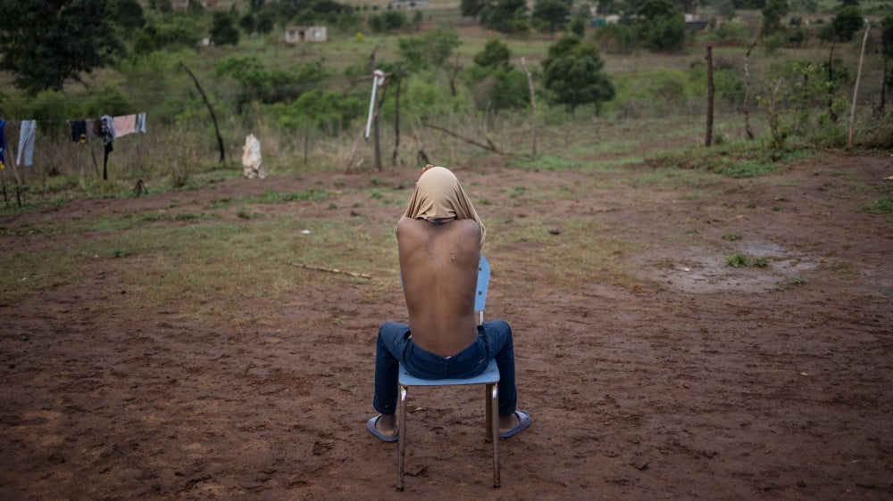 A boy shows a scar on his back allegedly from a rubber bullet 