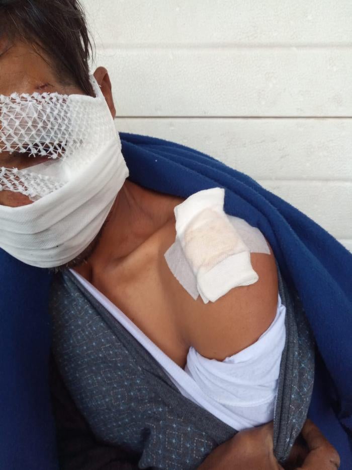 A migrant sustained severe head injury and a broken arm following a brutal beating by, what he stated was, six Croatian police officers during a pushback on October 16, 2020.&nbsp;
