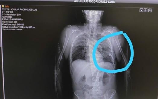 X-ray showing a marble lodged in Luis Aguilar Rodriguez&rsquo;s lung. Photo courtesy of Luis Aguilar Rodriguez&rsquo;s family.