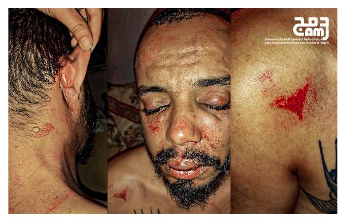 Badr Baabou, director of Damj Association for Justice and Equality, following his assault by suspected police officers in Tunisia. &copy; 2021 Badr Baabou