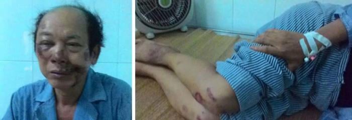 To Oanh after being assaulted in Bac Giang on July 13, 2016. 