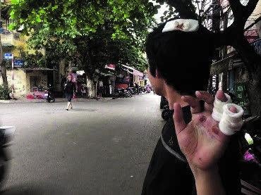 Trinh Anh Tuan after being assaulted in Hanoi on April 22, 2015.