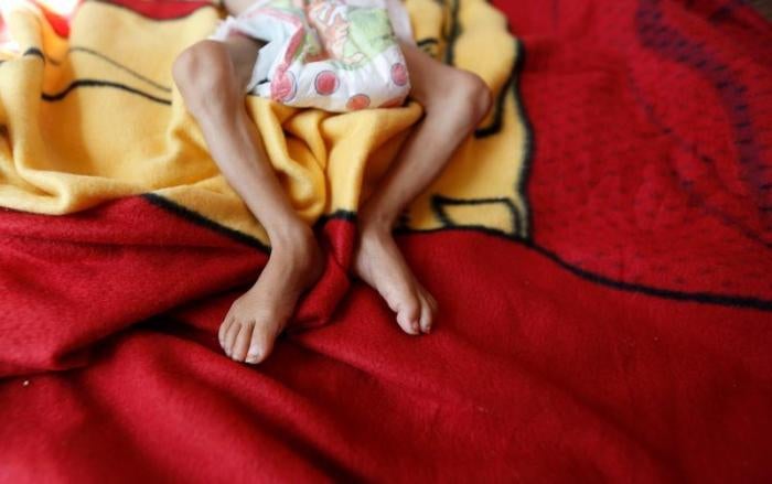 A malnourished boy lies on a bed at a malnutrition treatment center in Sanaa, Yemen, November 21, 2017. &copy; 2017 Reuters